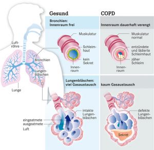 COPD 3